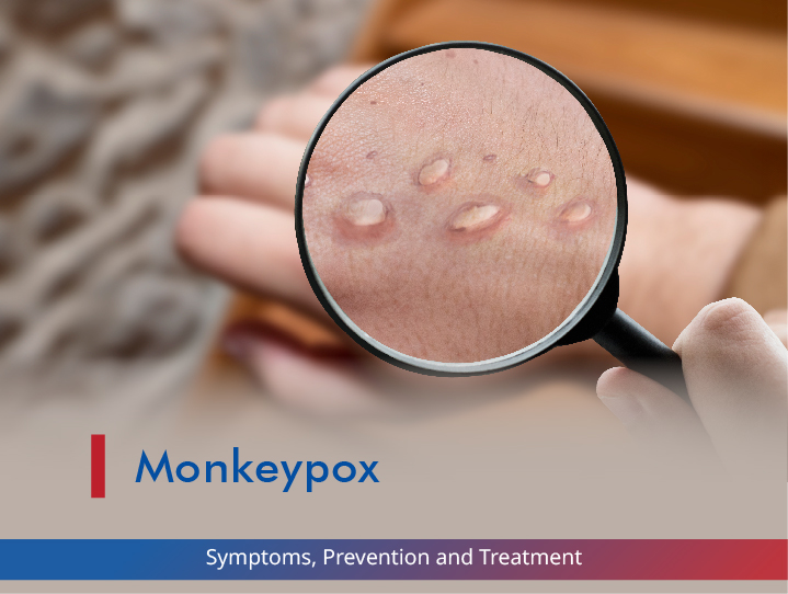 Understanding Monkeypox: Symptoms, Prevention and Treatment