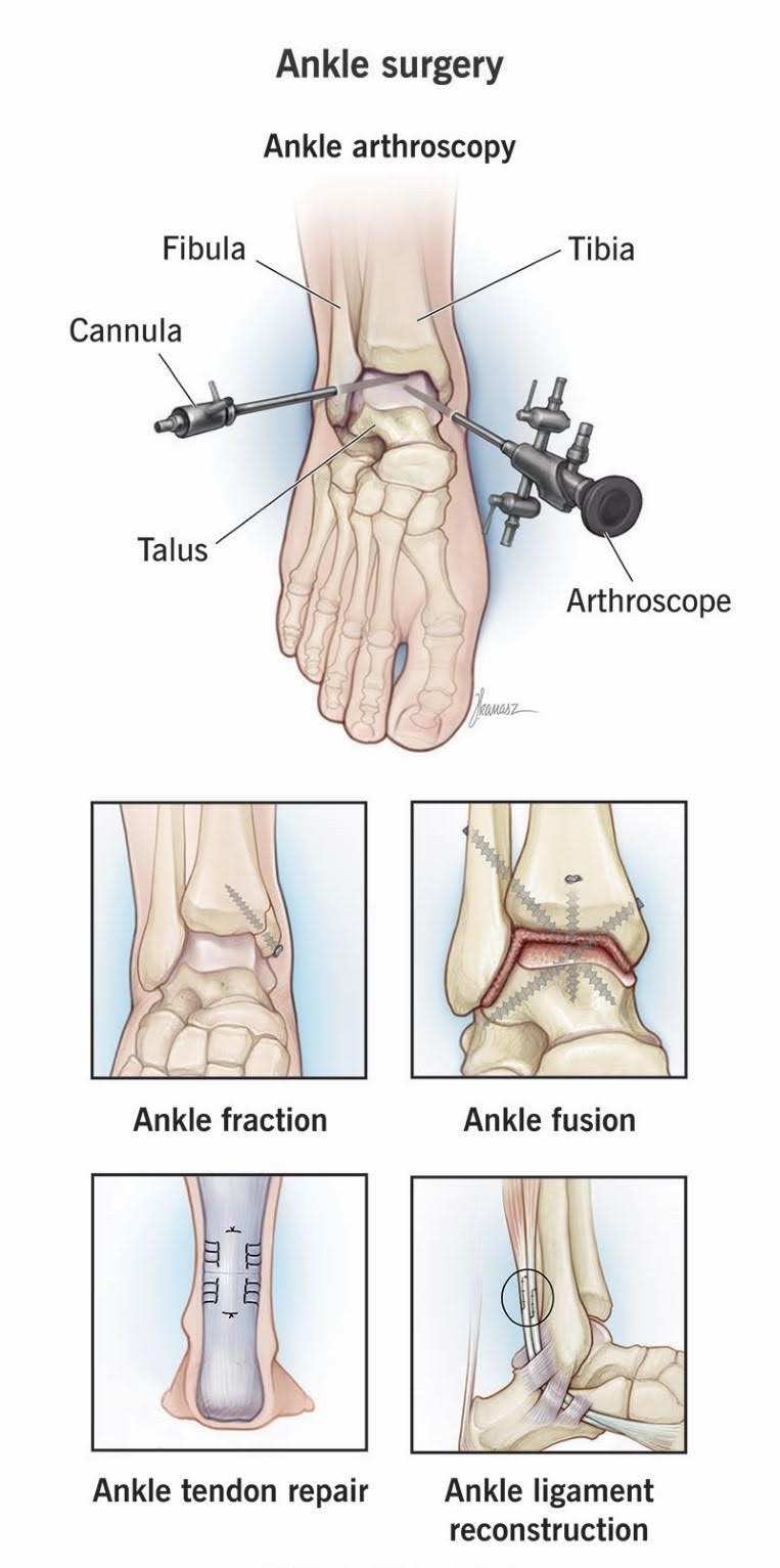 Foot and Ankle Surgery: What You Need to Know - SPARSH Hospital