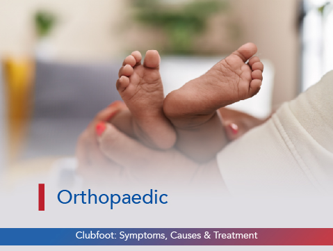 Clubfoot: Symptoms, Causes & Treatment