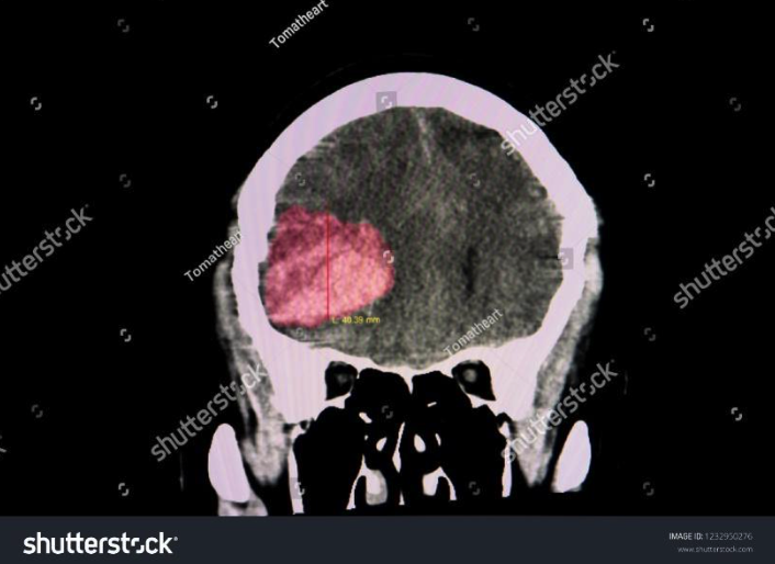 Blood Clot in Brain